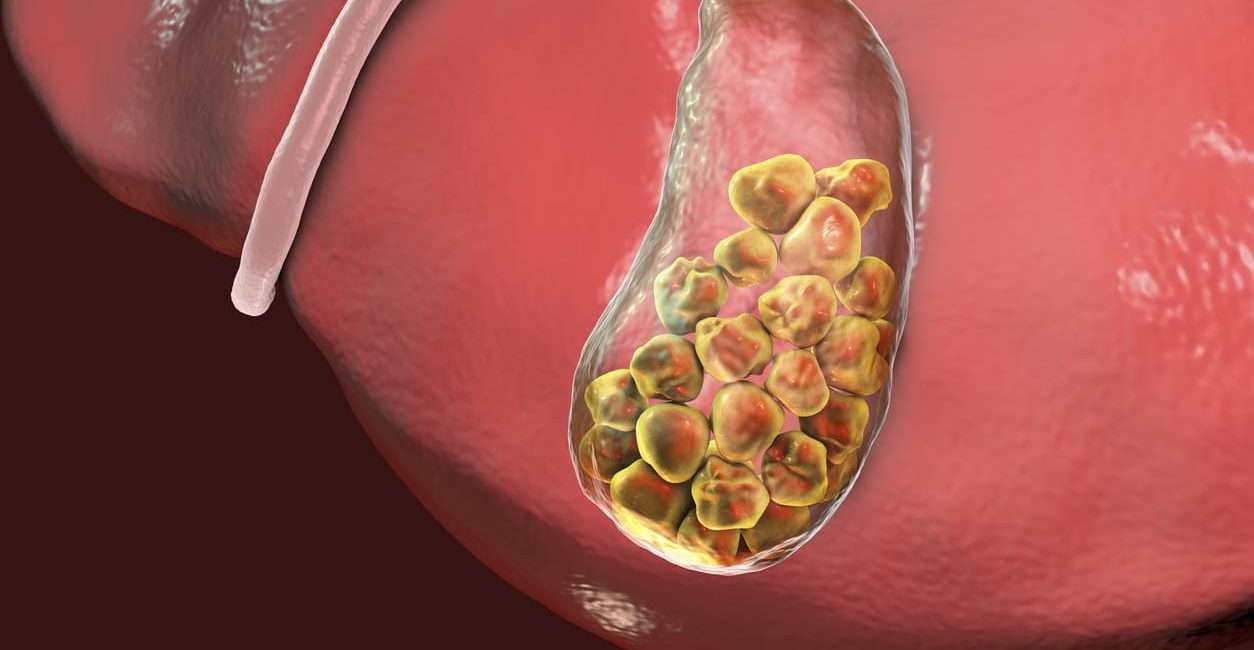penyebab batu empedu