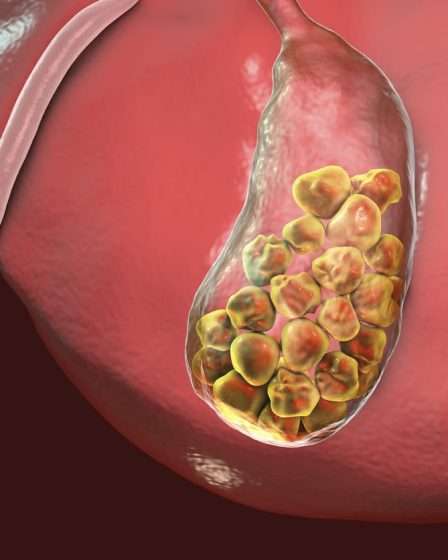 penyebab batu empedu